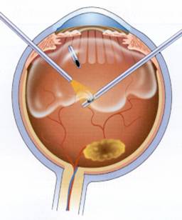  you take a vitrectomy for the treatment of the following disorders