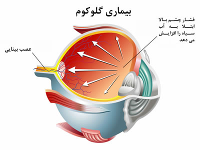 بینایی-چشم-چه تفاوتی بین گلوکوم (آب سیاه) و آب مروارید وجود دارد؟